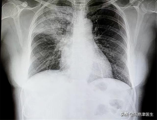 腫瘤ca125檢查多少錢（ca125檢查多少錢一次）