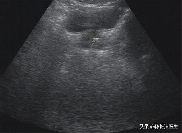 腫瘤ca125檢查多少錢（ca125檢查多少錢一次）